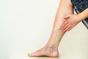 beinvenenschwäche behandlung wien